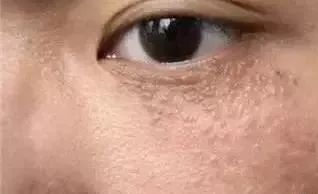 鼻梁和眼睛旁边的小颗粒有救了,鼻梁旁边有小颗粒怎么处理