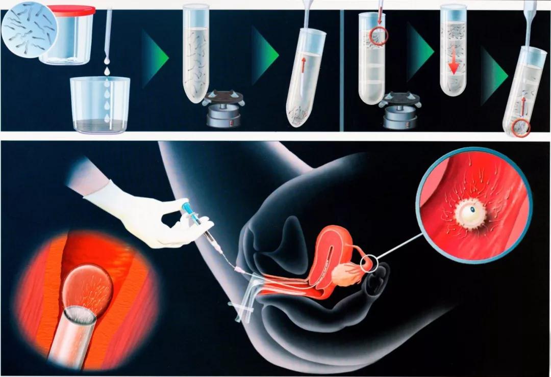 生殖科普及知识,关于人工授精知识