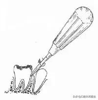 智齿很小一个自己就拔掉了,稍微晃动的智齿拔掉很快吗