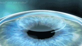 近视眼手术后的亲身经历2020,近视眼手术10年后的亲身经历