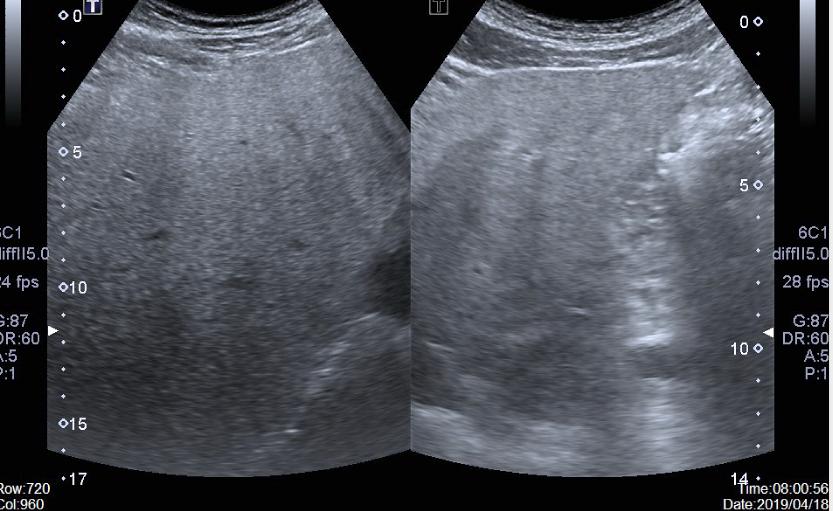 降低转氨酶护肝的药,清开灵对降低谷丙转氨酶有效吗