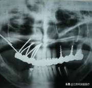 一篇文章带您走过种植体的前世今生
