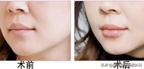 常见的唇部整形都有哪些,常见的唇部整形有哪些