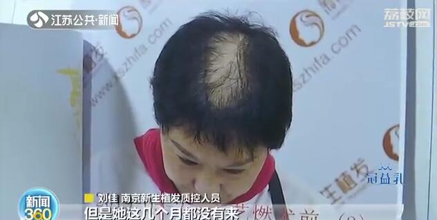 花一万多植发一年后头发没了,花4万植发却发现缺一块