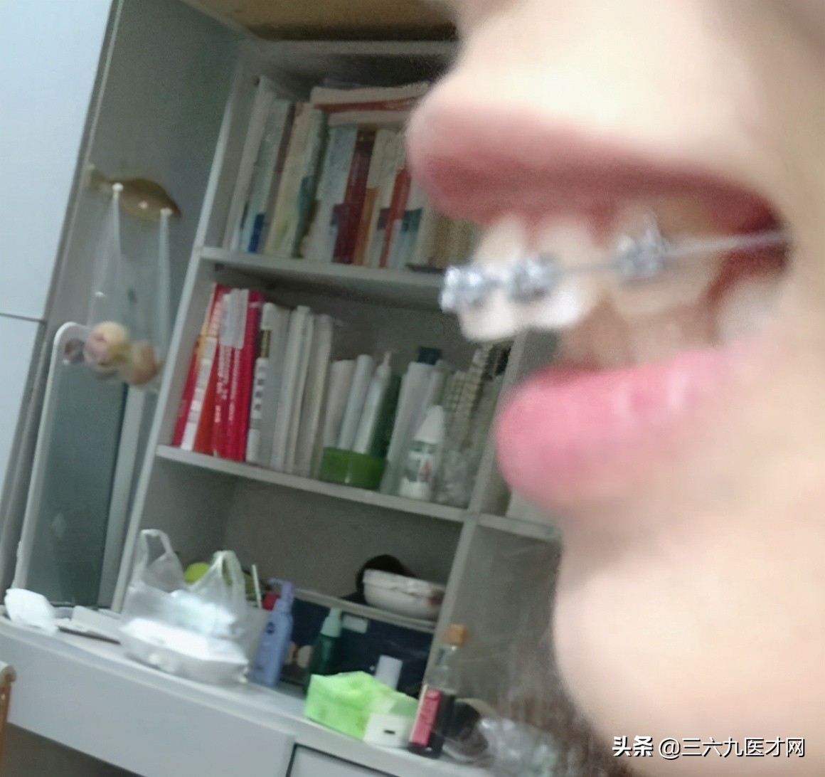 龅牙矫正成功的图片对比,2周岁龅牙可以矫正吗