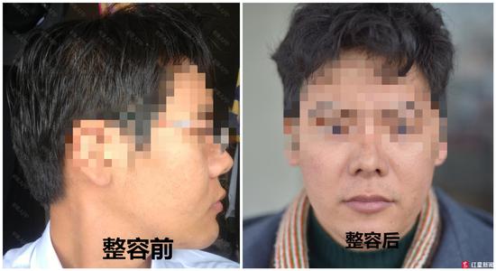 男子花10万隆鼻,男子花十几万隆鼻后来隆胸