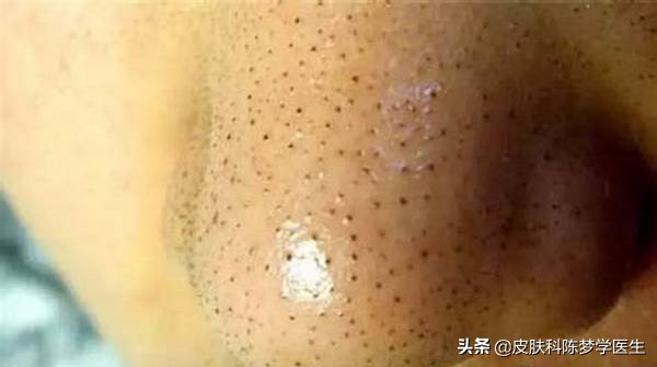 青春痘治疗最佳中成药,青春痘最好的治疗方案