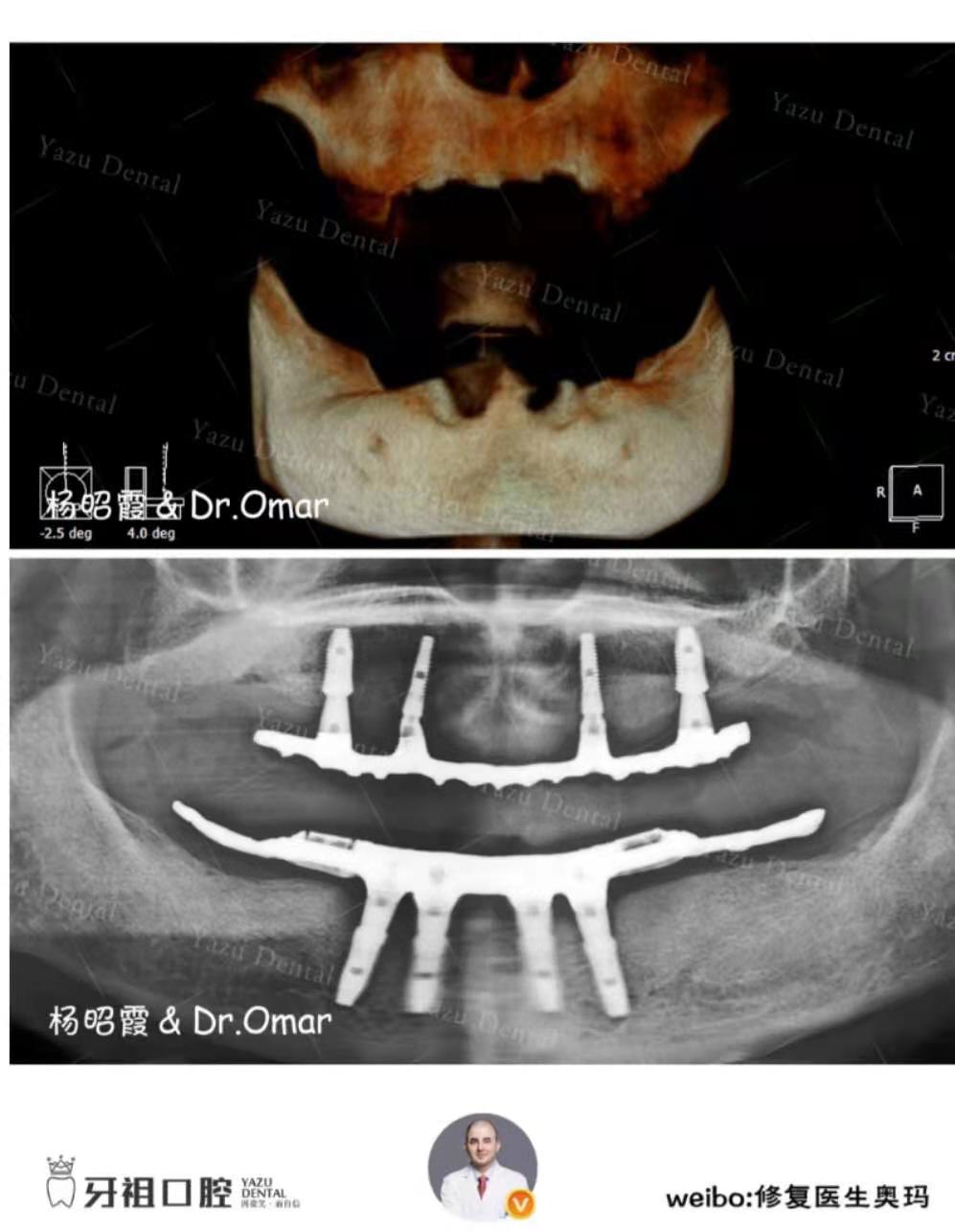 半固定种植牙几个牙钉,球帽式半固定种植牙优缺点