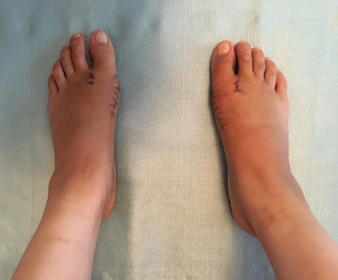 足底走路感觉骨头痛,足底痛是肾的原因吗