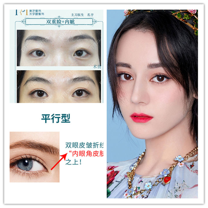 最好看的四种双眼皮内双,三种双眼皮哪种效果好