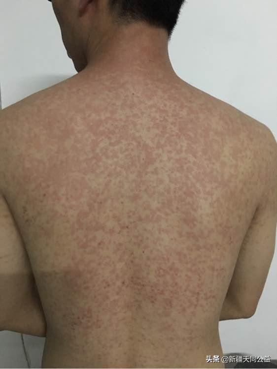 依非韦伦副作用以后可以消除吗,艾滋病依非韦伦最新用量