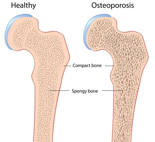 膝盖长骨刺怎么去掉骨刺,具有骨刺的骨刺是什么症状