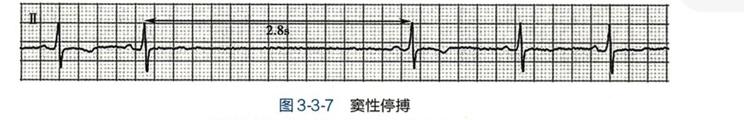 心律失常总结分析,各种房性心动过速心电图解析
