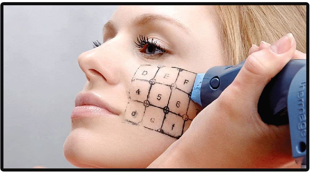 张雨绮说做超声刀就像在烤肉?我去体验了一把……