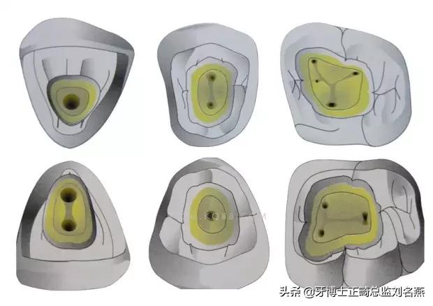 根管治疗难点与解决方案,根管治疗牢固吗