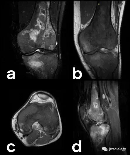 磁共振天天诊断骨髓水肿，但您知道原因吗？