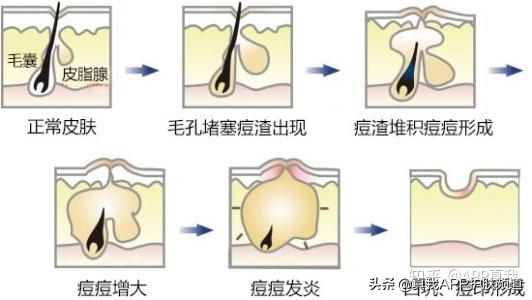 全球最好用的五款去痘印产品！每一款都火爆全网，有没有你用过的