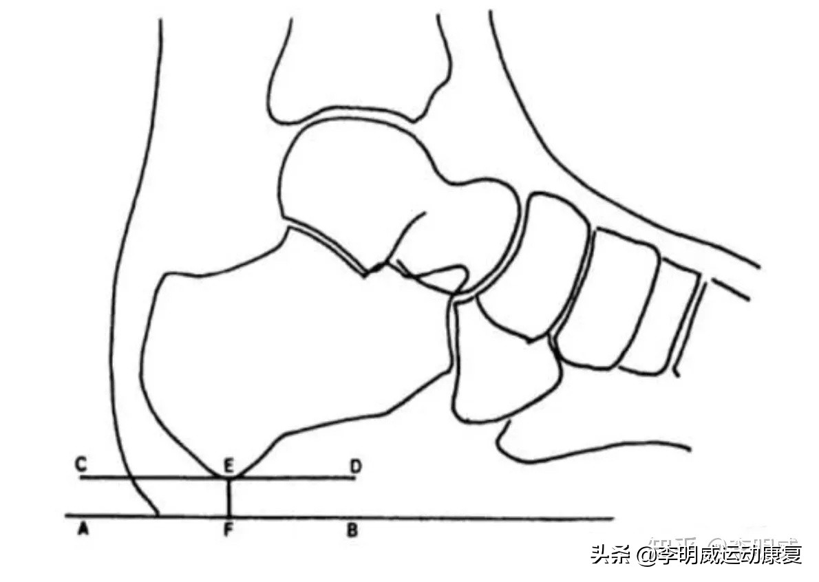 足跟痛的自我治疗方法,足跟痛艾灸的治疗方法