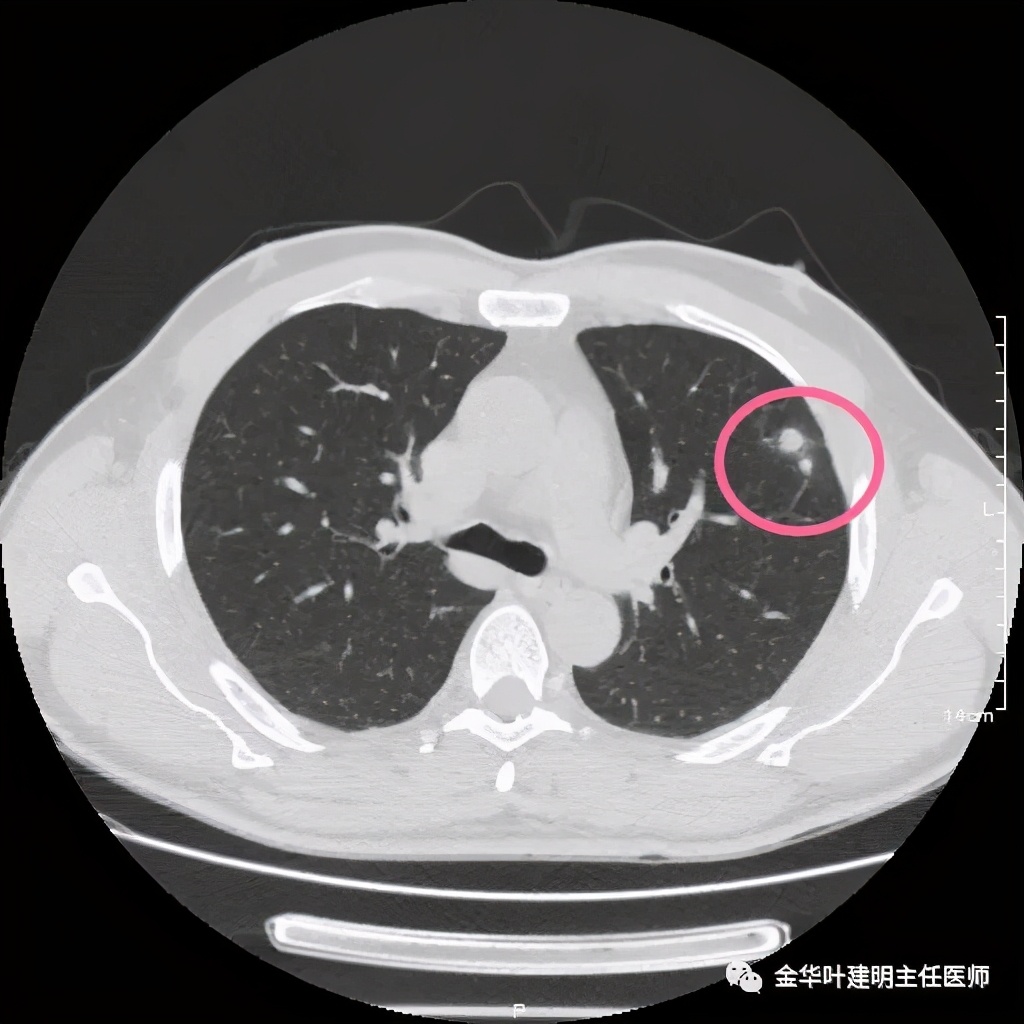 叶建明谈肺结节:一招分辨隐球菌性肉芽肿与肺癌