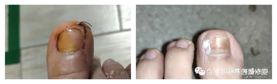 自己剪掉甲沟炎肉芽自己会消掉吗,甲沟炎拔甲后复发的几率多大