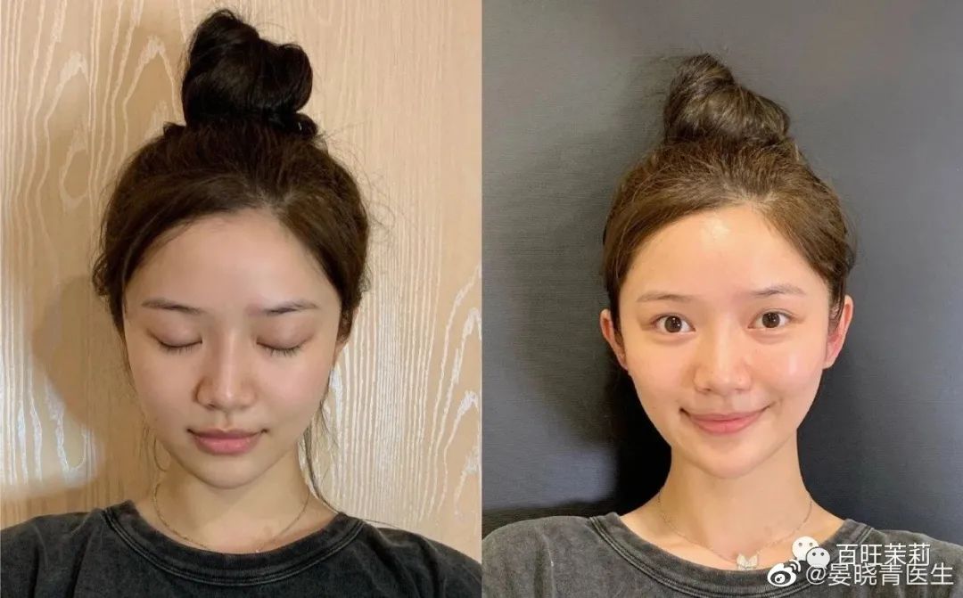 挑筋断骨切胃，那些为了美不要命的女人到底有多可怕