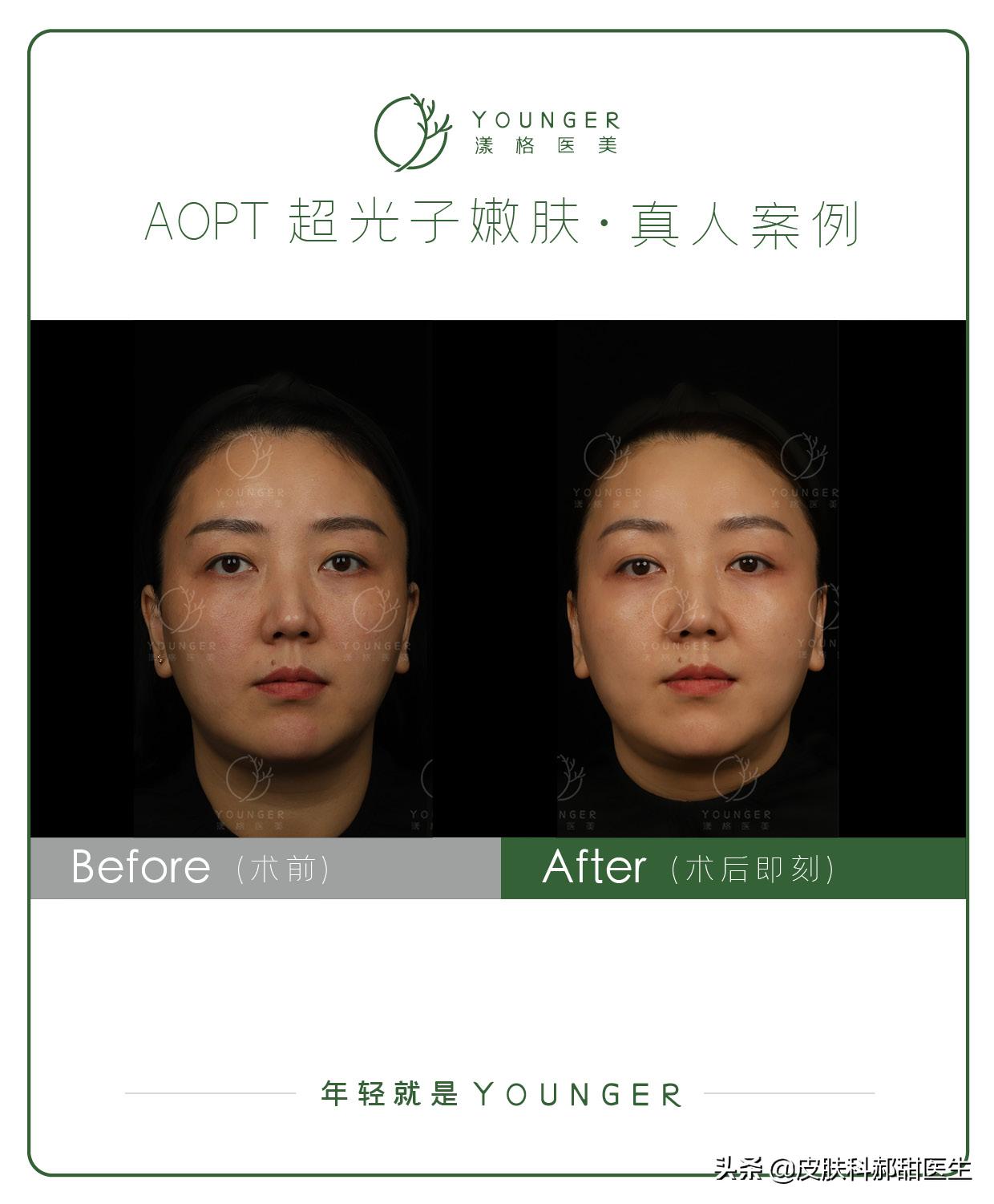 aopt光子嫩肤去红美白效果怎么样,医美光子嫩肤的操作方法