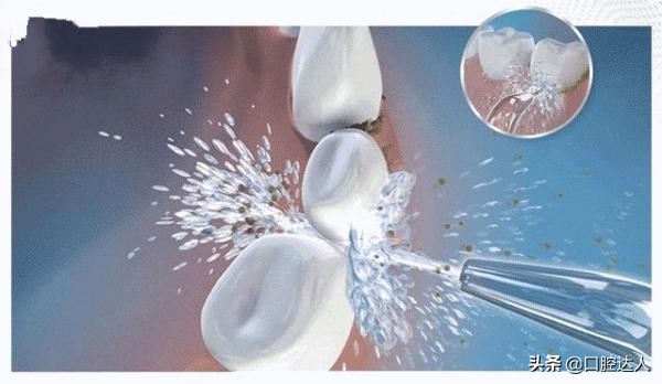 有蛀牙可以去洗牙吗,蛀牙洗牙治疗视频