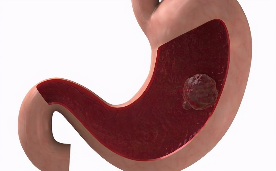 中医认为息肉是什么原因导致的,息肉切完以后脾胃很虚吗