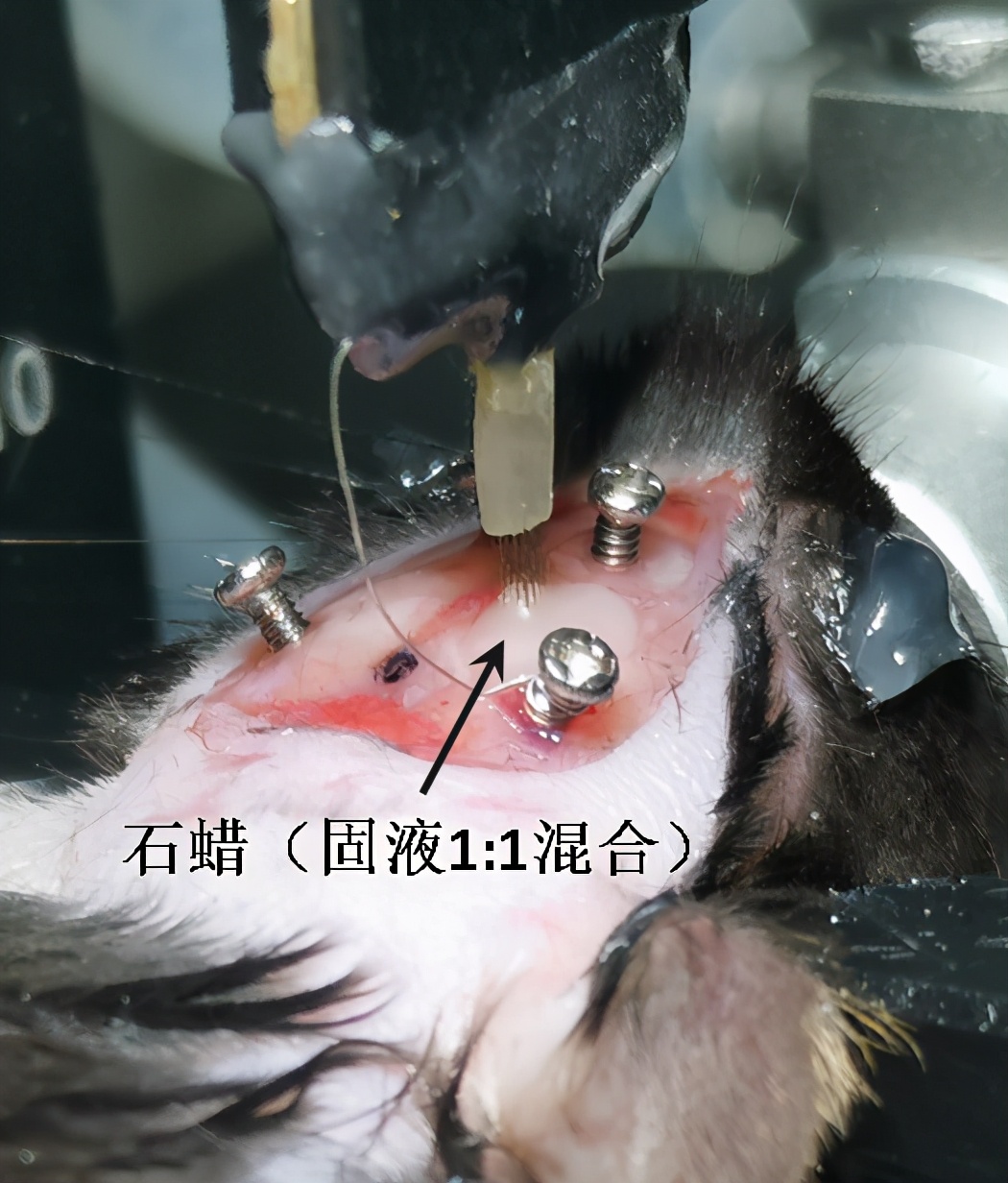 晶体植入手术的分享,可调微丝阵列电极