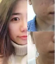 怎么填补脸上的痘坑,痘印痘坑修复激光手术