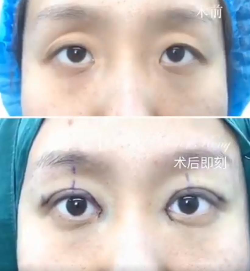 凹眼皮适合做双眼皮吗,眼窝凹陷眼睛突双眼皮不明显