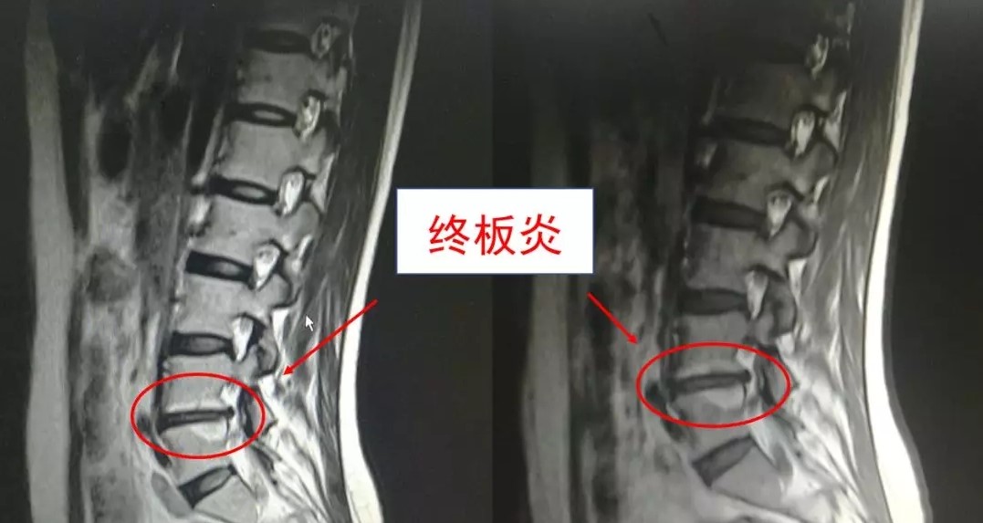 医林正骨丨妙手治腿痛，腰椎间盘突出名中医有绝招