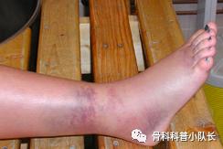 刚崴脚是要冷敷还是热敷,崴脚后24小时内是热敷还是冷敷