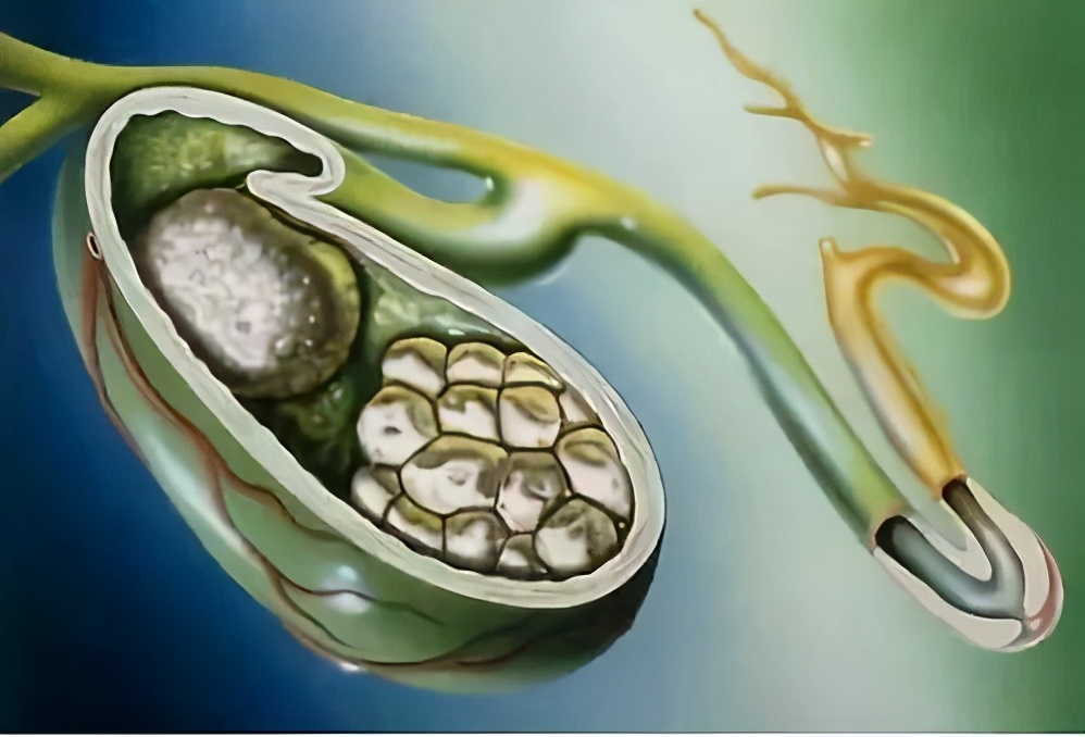 胆结石一般什么地方出现疼痛,胆结石的疼痛在什么地方