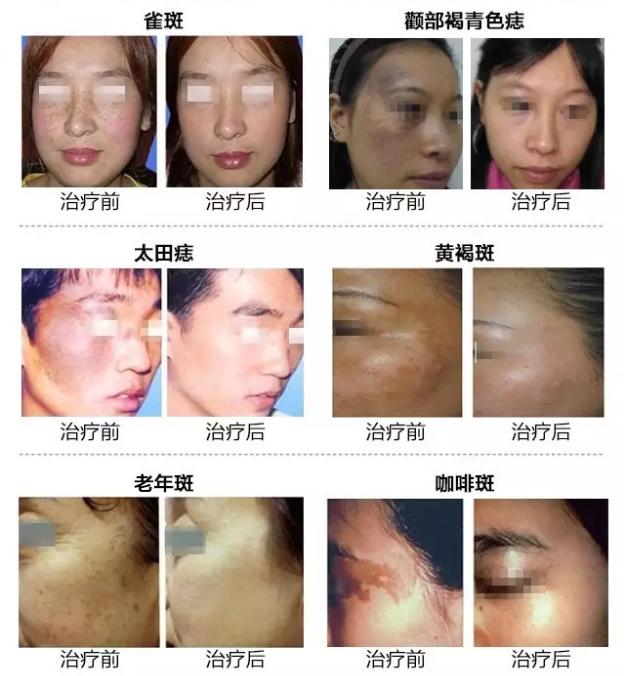 皮秒激光祛斑后怎么预防反黑,皮秒祛斑会反黑吗