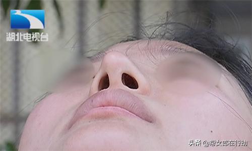孕妈花高价垫鼻梁，不料术后歪成“蛇精”，医院：最多退4000
