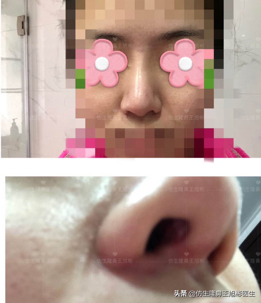 隆鼻鼻头大是失败了吗,大鼻头隆鼻手术案例