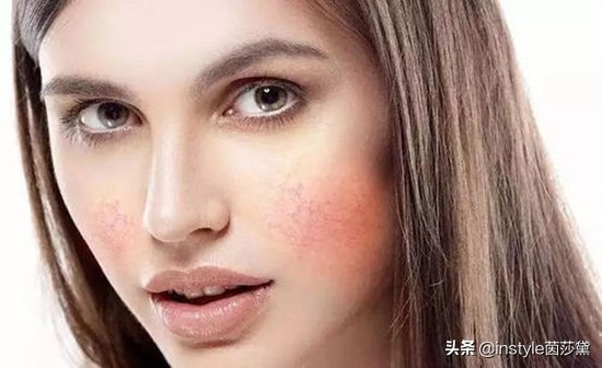 防腐剂过敏用什么药膏,卡松防腐剂皮肤过敏怎么用药