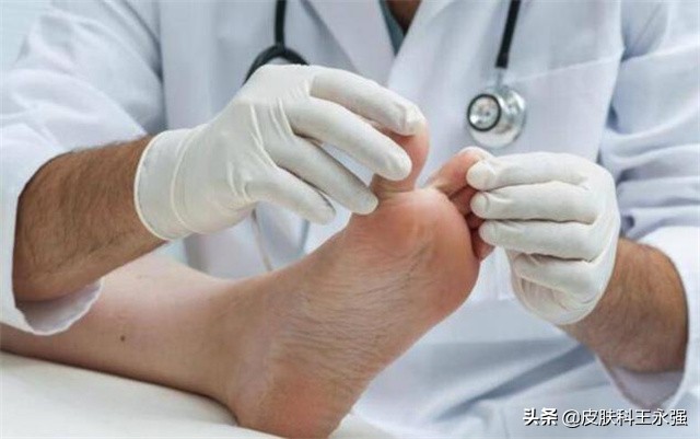 医生治汗疱疹的方法,汗疱疹奇痒无比如何缓解