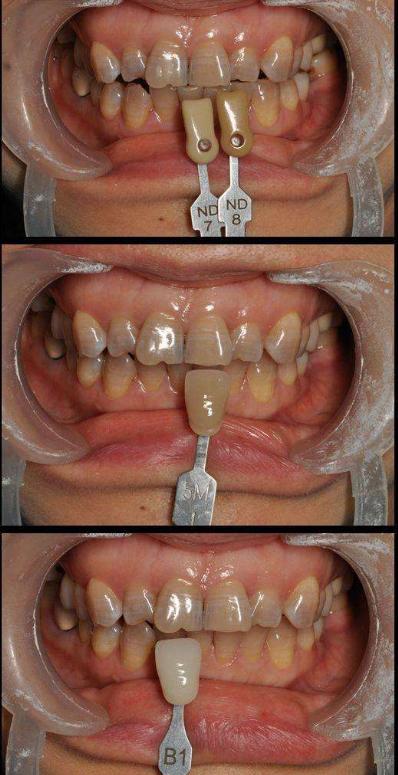 什么是美牙冠矫正,美牙冠对于龅牙效果好么