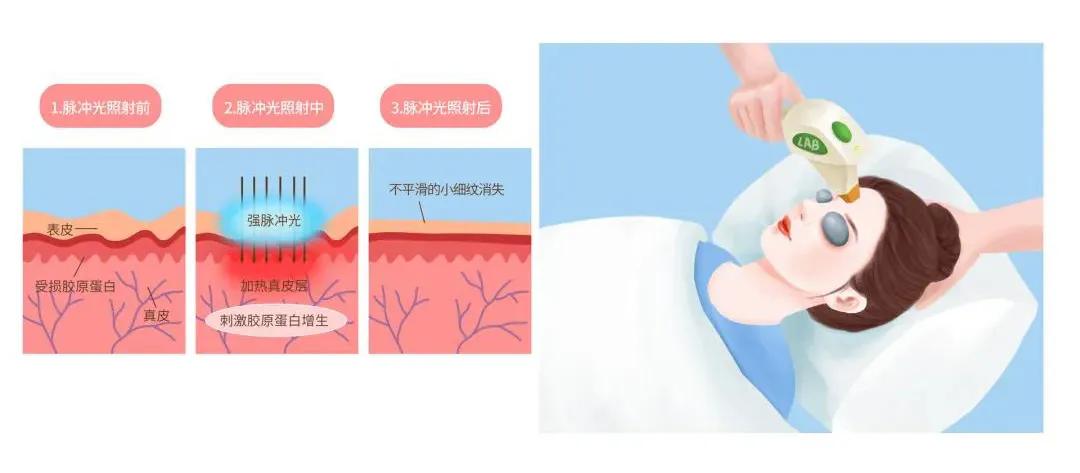 山东济南光子嫩肤医院排名,青岛山东大学齐鲁医院光子嫩肤