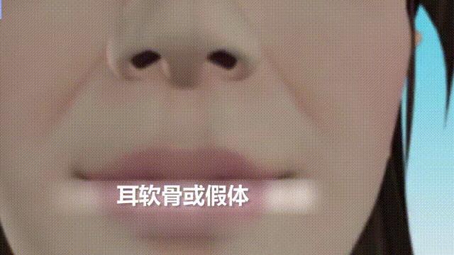 想做隆鼻的女孩,肋软骨填充鼻基底会拉长人中吗