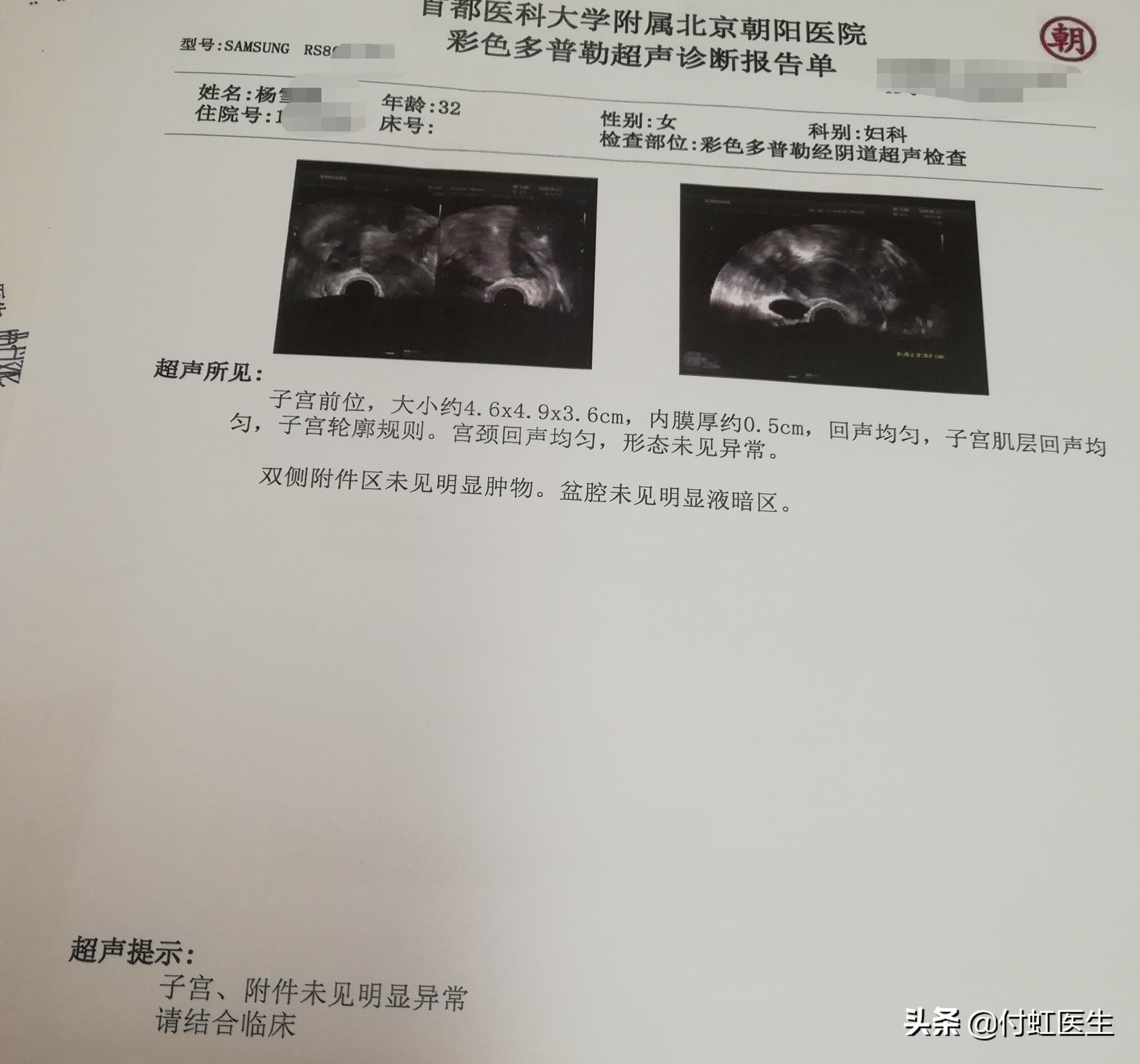 b超检查内膜回声不均是怎么回事,b超子宫内膜回声不均是怎么回事