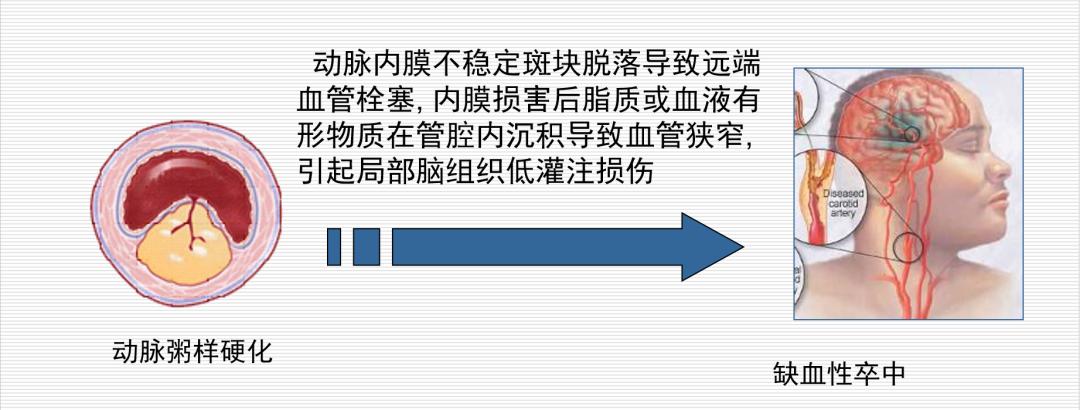 世界卒中日识别脑卒中谨记120口诀,名医话健康警惕缺血性脑卒中