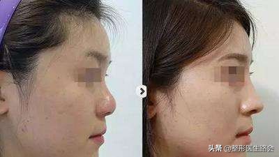 鼻子是怎么垫高的,鼻子垫高点更完美了