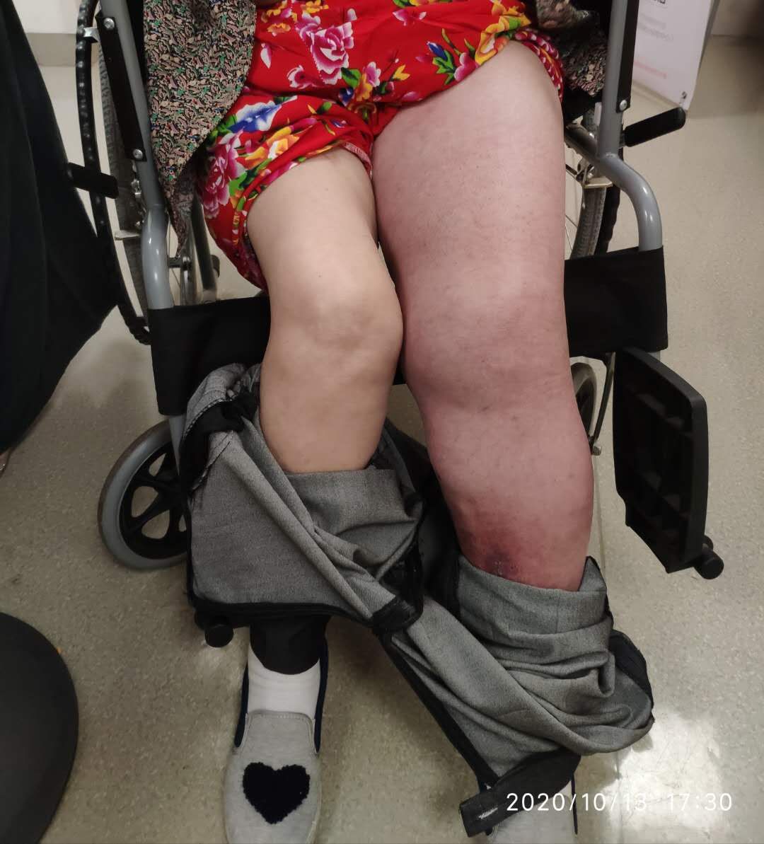 如何避免久坐导致的腿肿,女性长期久坐腿肿容易得什么病