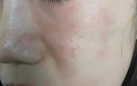 冬季干燥皮肤瘙痒症的治疗方法,冬季下肢皮肤干燥瘙痒用什么药