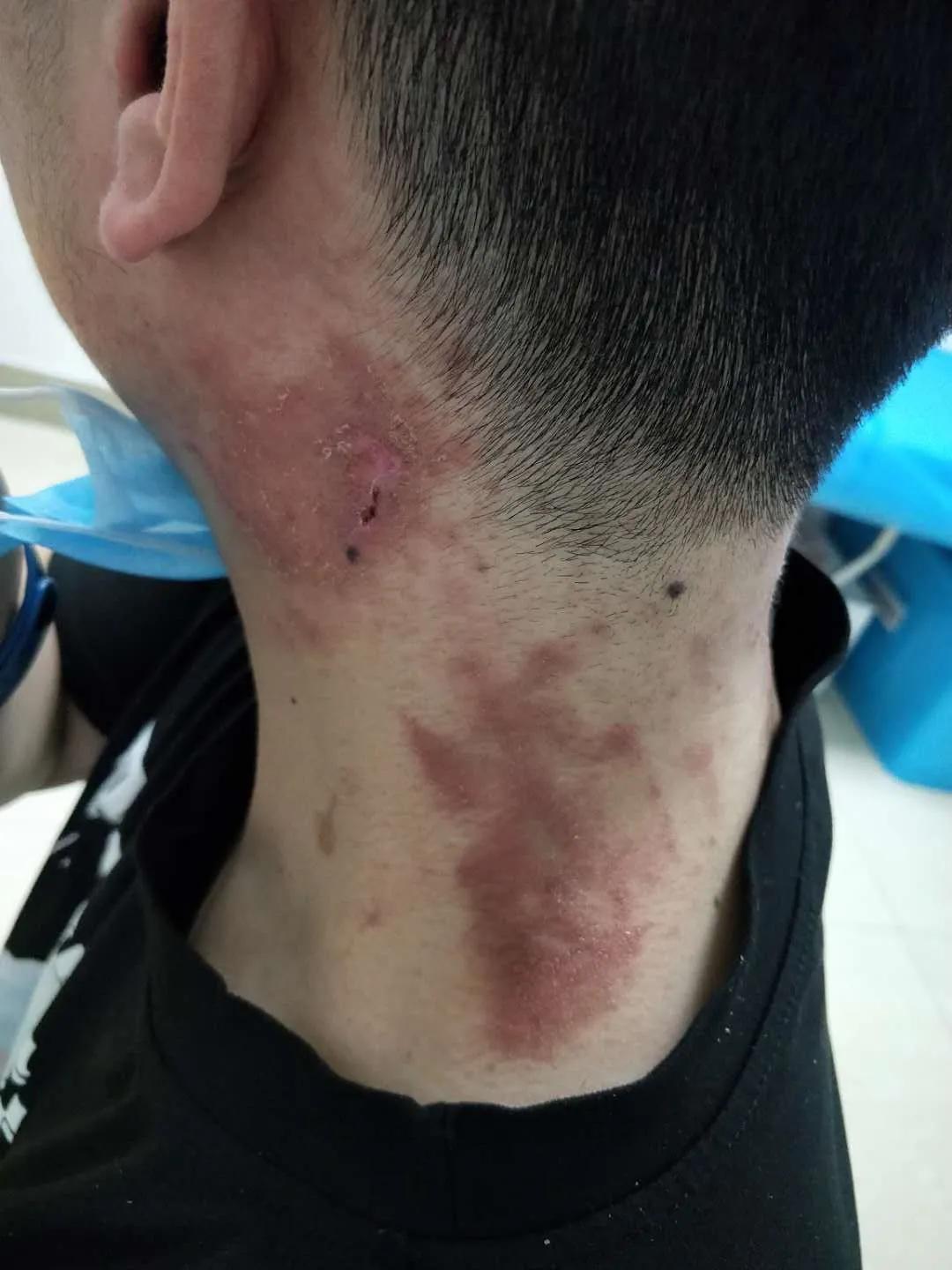 小伙随手捏死一只虫,一觉醒来满脸脓包!这些虫不能拍,严重可致命