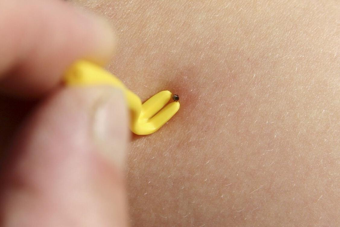 蜱虫咬到孩子之后会出现什么症状,蜱虫虽小危害大一旦被咬如何处置