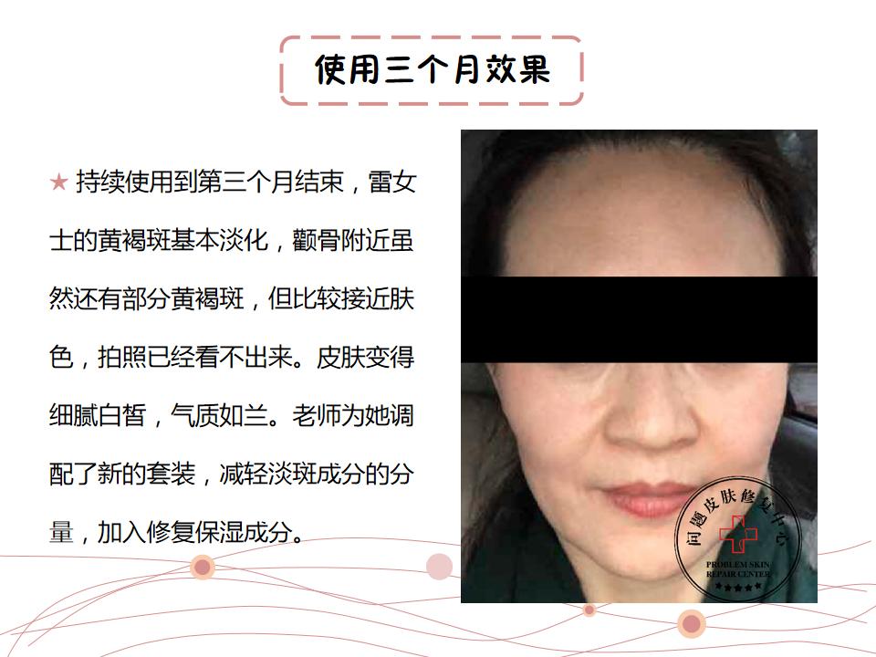 激光祛斑反黑修复过程,st修复祛斑最佳方法